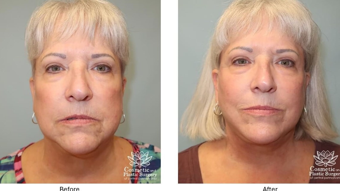 Facelift